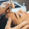 Close-up of professional microneedling treatment on woman’s face in a clinic