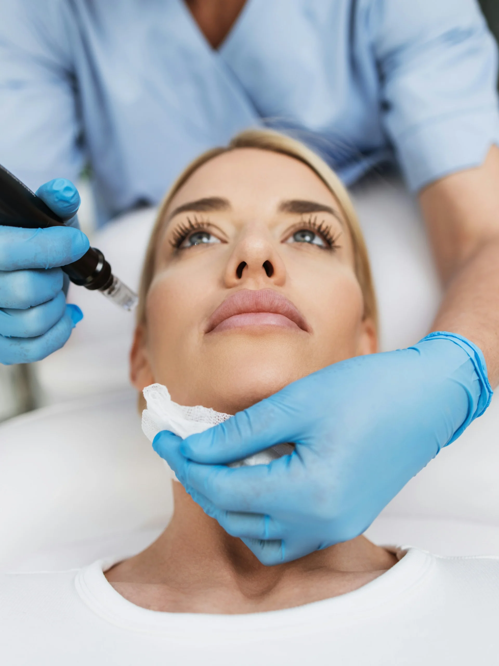 Close-up van het gezicht van een vrouw die ontspannen op een behandelbed ligt en een microneedlingbehandeling ondergaat in een kliniek